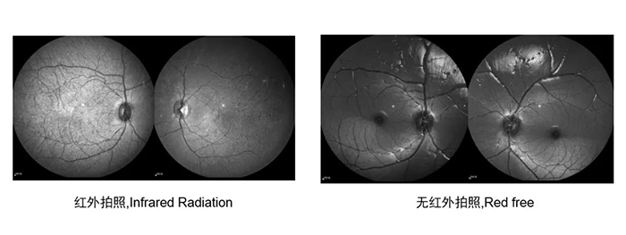 SPECTRALIS®HRA + OCT